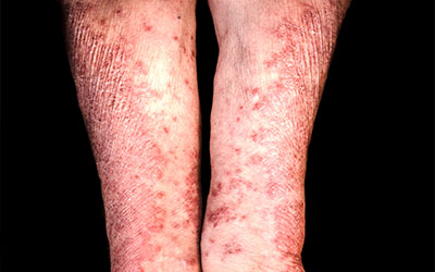 Psoriasis Management; Patient Feedback and Healthcare Limitations