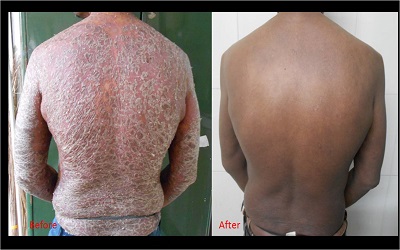 IL 17 Cytokine in Psoriasis: Before and After Methotrexate and NBUVB Phototherapy: A Longitudinal Study