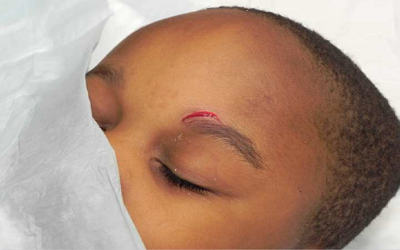 The Use of 2-Octyl Cyanoacrylate Skin Adhesive for Laceration Repair in the Emergency Department