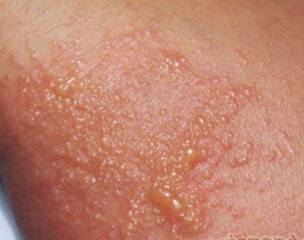 Two Cases of Atopic Dermatitis that Healed Completely after Several Intradermal Injections with Non-Specific Antigen Preparation