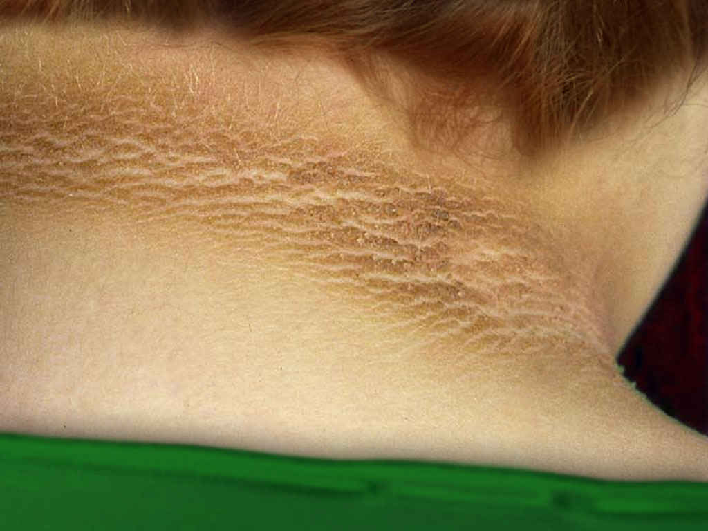 Metformin as Adjunctive Therapy in Acanthosis Nigricans Treatment: Two Arms Single Blinded Clinical Trial