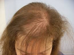 “Nail-Like Appearanceâ€: Characteristic Feature of Hair Fracture Caused by Hair Dye under Dermoscopy