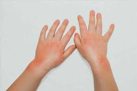 Erythematous Papules and Patches on the Hands