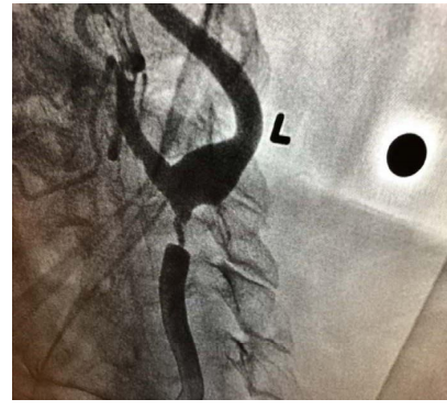 Candle-Flame-Like Stenosis Carotid Lesion