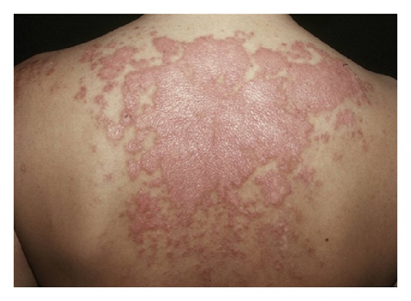 The Effectiveness of Hydroxychloroquine Treatment In Cutaneous Lupus Erythematous