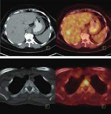 The Role of Pet-CT in the Evaluation of Hepatic Tumors