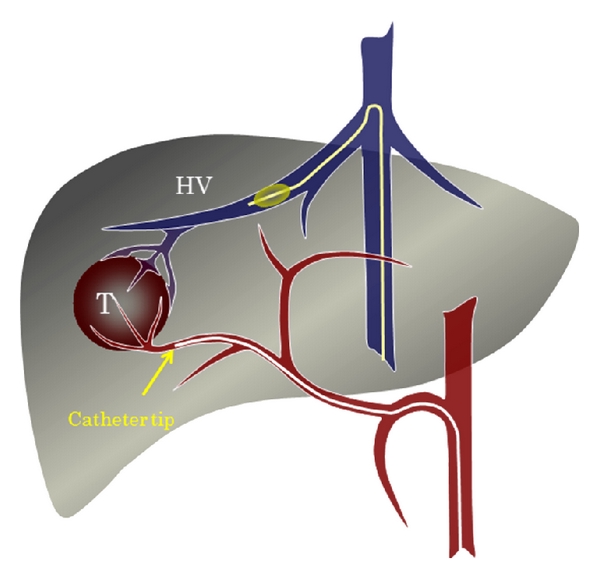 Transarterial Chemoembolization in Hepatocellular Carcinoma