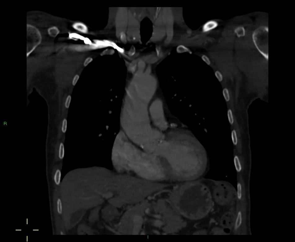 Role of Barium Swallow and Multislice CT Scan in The Estimation of Oesophageal Tumour Length