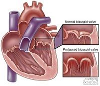 A Rare Case of Multivalvular Prolapse