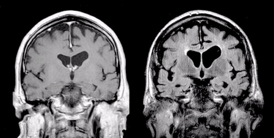 A Brief Note on Alzheimer's Disease in Brain Imaging