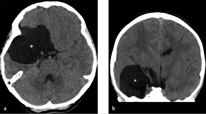 Diagnosis of Arachnoid Imaging Cyst