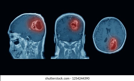 Brain Abscess: A Brief Overview