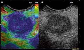 Breast Elastography:  A Diagnostic Breast Imaging