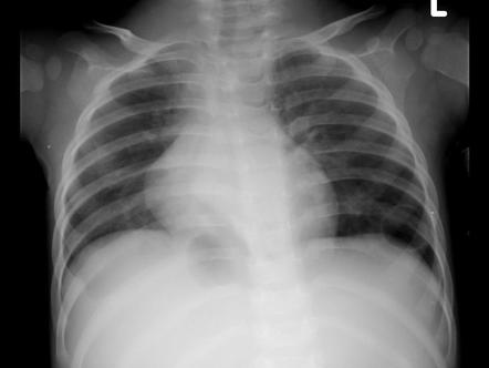 An Iatrogenic Pneumatocele