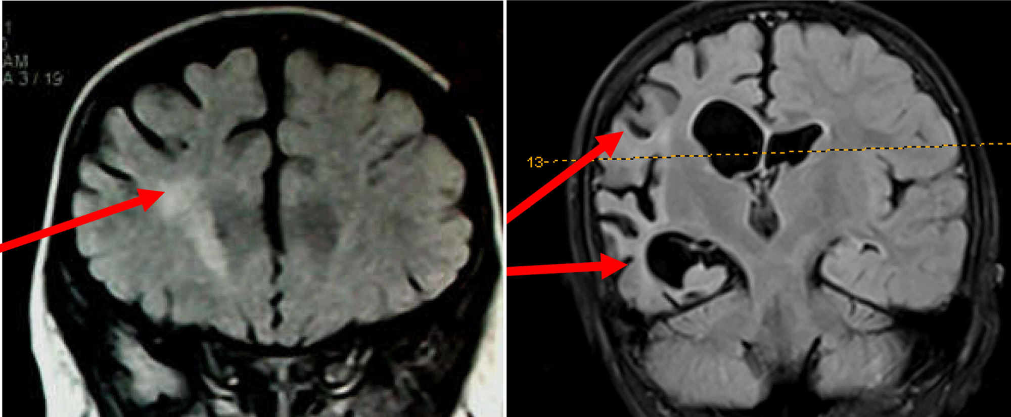 Role of Magnetic Resonance Imaging in Epilepsy
