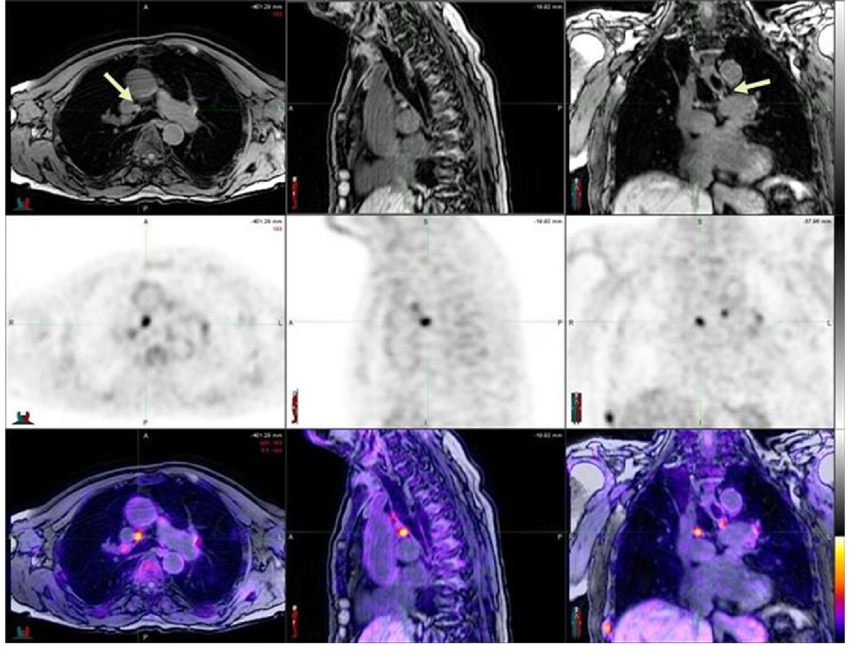 The Role of Positron Emission Tomography/Magnetic Resonance Imaging