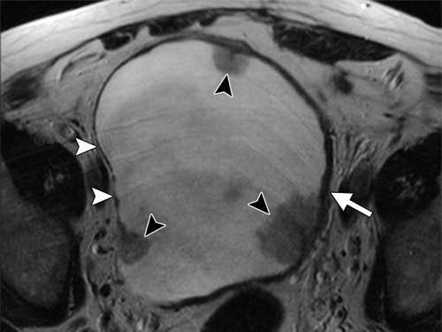 Role of MRI in Diagnosis of Urinary Bladder Carcinoma