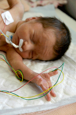 A case of Infections in a Premature  Infant and Repeated Apnea