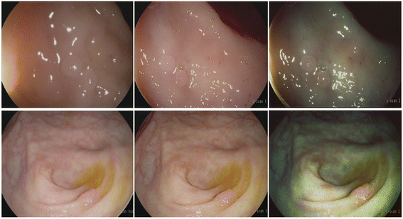 Chromoendoscopy Used to Increase the Detection Rates for various Pathologic Processes During Endoscopy
