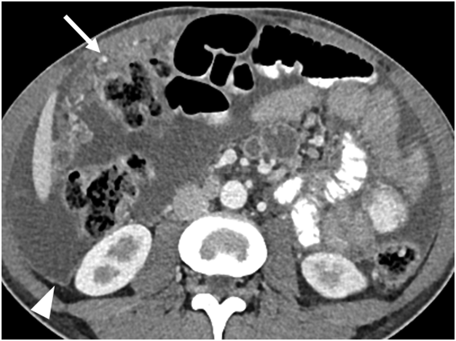 Magnetic Resonance Evaluation of Abdominal Tuberculosis