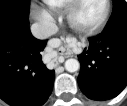 Multidetector Computed Tomography in Esophageal Varices