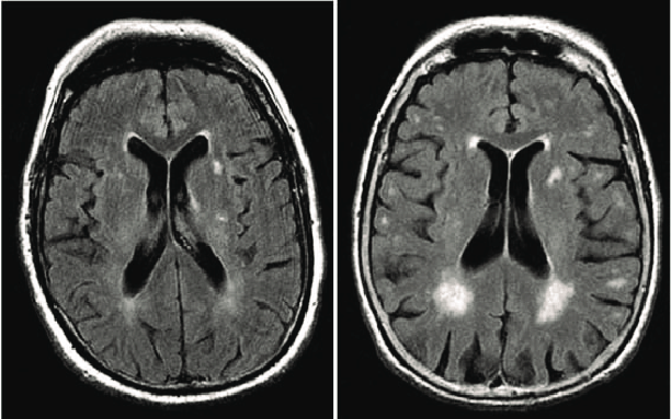 Role of Magnetic Resonance Imaging in White Matter Diseases