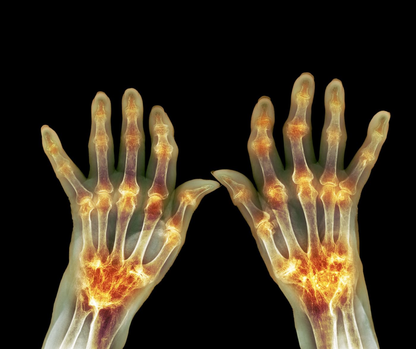 Sonographic Spectrum of Rheumatoid Arthritis