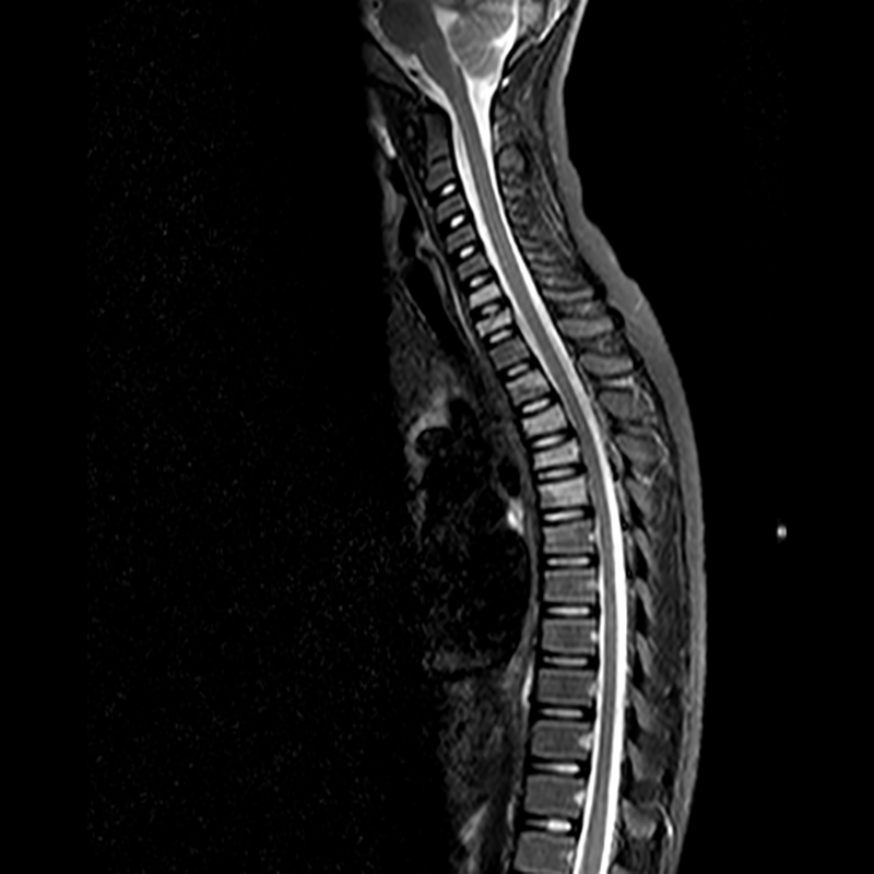 Evaluation of Spinal Trauma by MRI