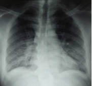 Diabetic Keto Acidosis and Hyperosmolar Hyperglycemic State, Diagnosis and Management Challenges at Regional Referral Hospitals, A Case Series from umbi Regional Referral Hospital, Pwani, Tanzania