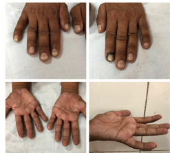 Cutaneous Agrochemical Exposure Causing Arsenic Toxic Neuropathy