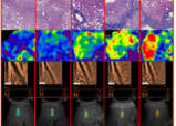 Diagnosis of Liver Fibrosis by Ultrasound Elastography in Patients with Chronic Diseases