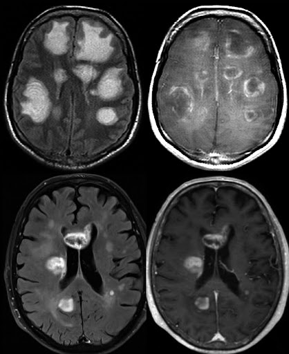 Role of Diffusion Magnetic Resonance Imaging in Assessment of Neoplastic and Inflammatory Brain Lesions