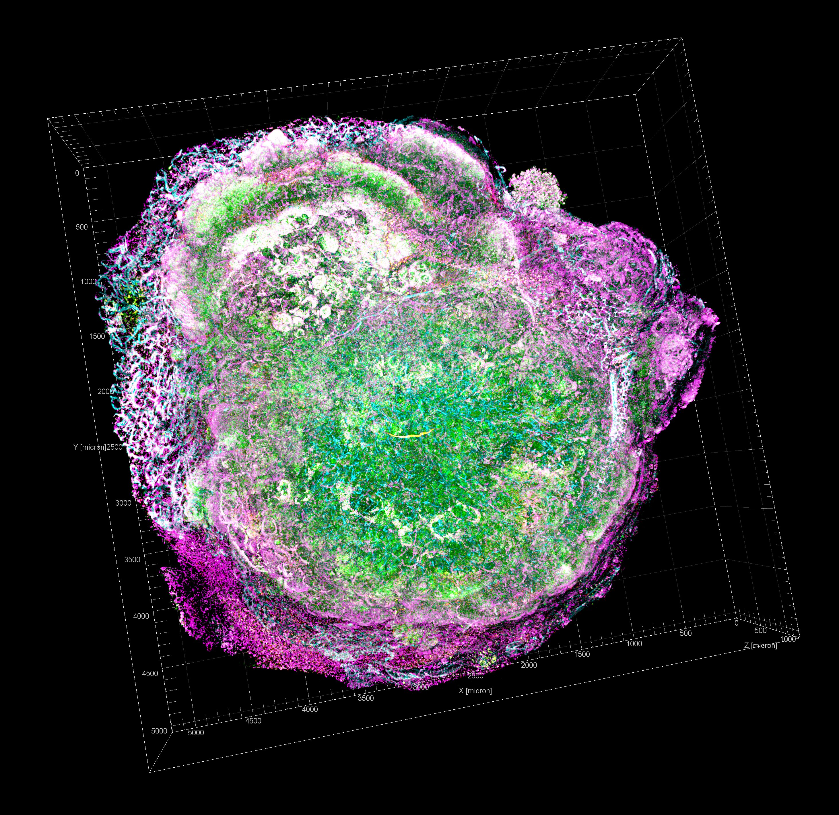 Sonoelastography Role in Estimating Neoadjuvant Chemotherapy Response in Patients with Progressed Breast
Cancer
