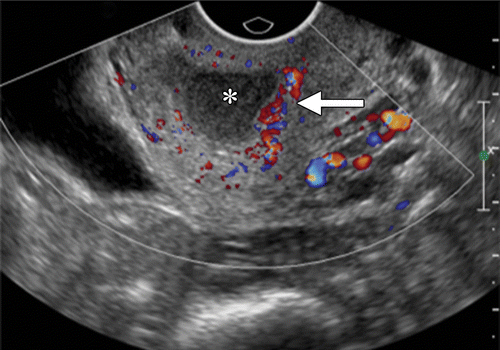 The Role of Ultrasound and MRI in Acute Pelvic Inflammatory Disease