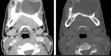 Role of Multidetector Computed Tomography in Assessment of Jaw Lesions
