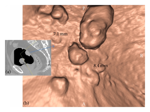 Role of CT Virtual Cystoscopy in Diagnosis of Urinary Bladder Neoplasia