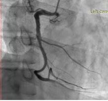 Dead Man Sign of ECG- a Unique Predicting Sign of Acute Coronary Syndrome