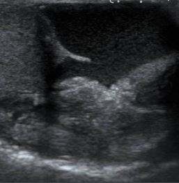 Role of Gray Scale and Colour Doppler Ultrasonography in the Evaluation of Neonatal Cholestasis