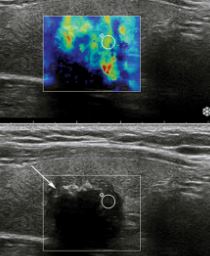 Evaluation of Thyroid Nodules by Ultrasound Elastography Using Acoustic Radiation Force Impulse (ARFI) Imaging