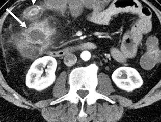 Role of Multislice Computed Tomography in Evaluation of Crohns Disease