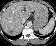 Evaluation of Focal Liver Lesions by Colour Doppler and MDCT Perfusion Imaging