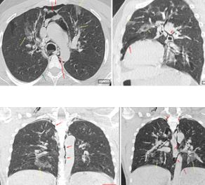 A Very Rare Complication of Covid-19: Pneumothorax and Penumomediastinum