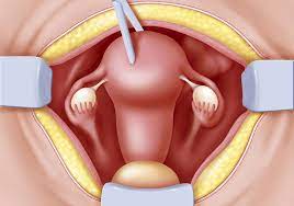 A Very Rare Case of Intussusception Following Abdominal Hysterectomy