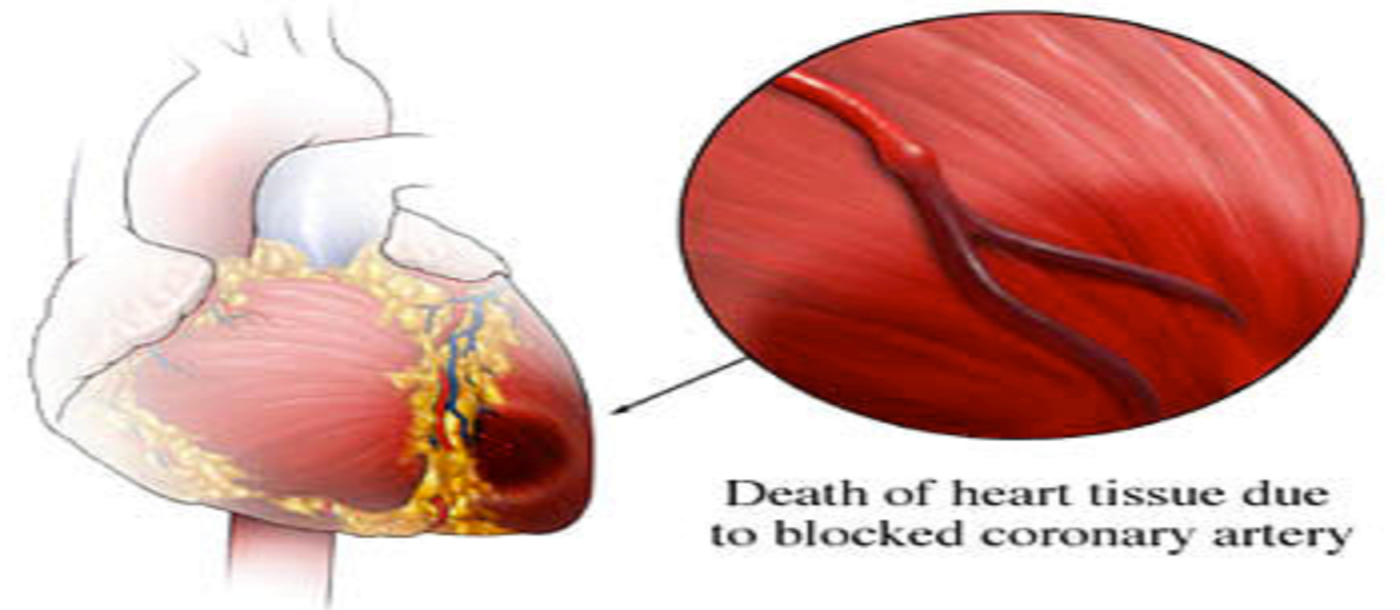 Unusual Acute Myocardial Infarction in Young Male with Hereditary Protein C and S Deficiency