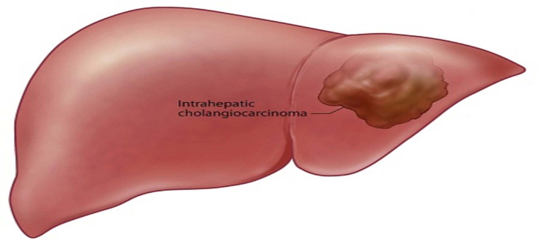 An Unusual Finding of Dilated Stomach in the Pelvic Cavity Secondary to Gastric Outlet Obstruction by Cholangiocarcinoma