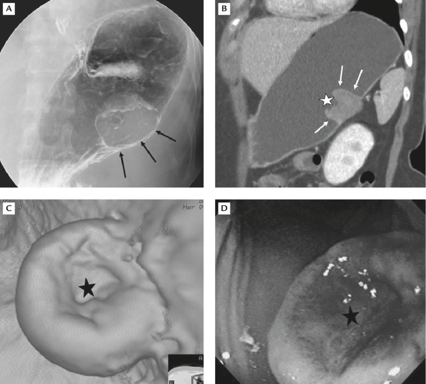 Unusual Sanctuary Site (Central Nervous System) Metastases in Gastrointestinal Stromal Tumor Patients