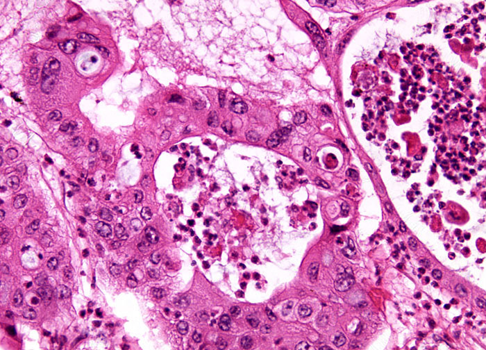 Primary Squamous Cell Carcinoma of the Liver