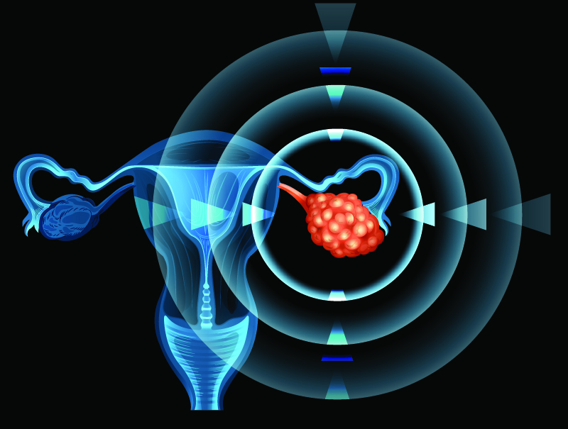 Î‘ Rare Solitary Spinal Cord Metastasis after Epithelial Ovarian Cancer Diagnosis