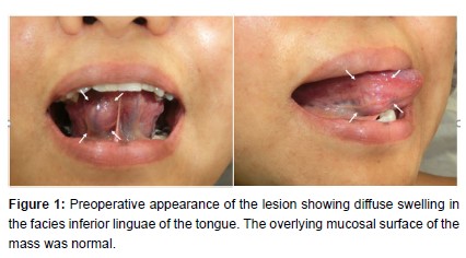 Angioleiomyoma in the Facies Inferior Linguae: A Rare Case and a Literature Review