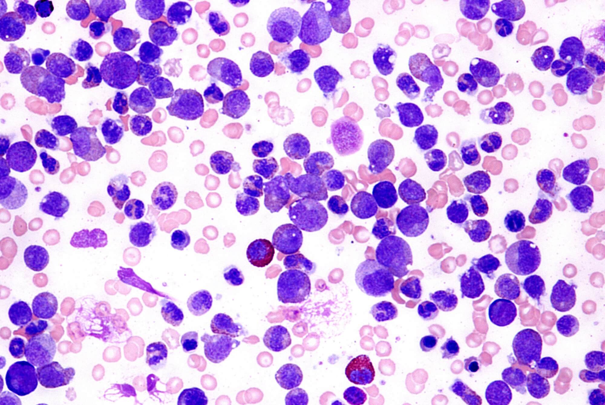 The Combination of Ponatinib and Alpha-Interferon can Improve Outcome of Resistant Chronic Myeloid Leukemia Patients